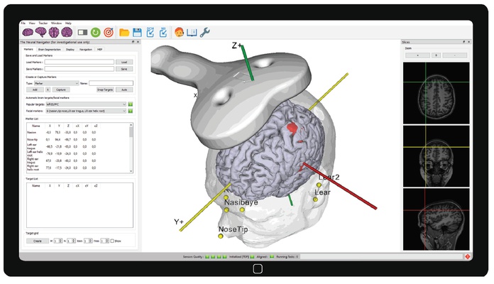 Added value of MRI-guided neuronavigation