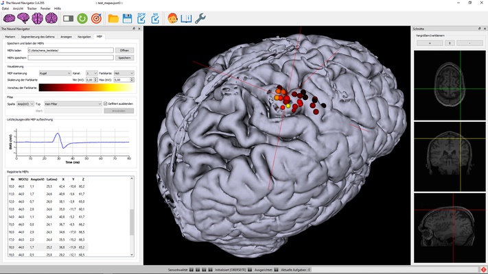 TMS motor mapping in stroke