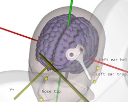 Reproducible coil placement using MNI