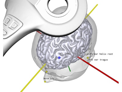 MRI-guided neuronavigation